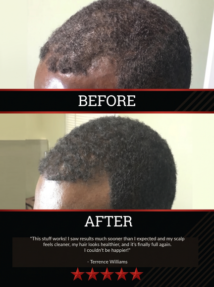 The All-Natural Hair Growth Solution by Black Widow® (Buy More & Save)