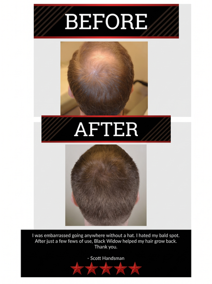 The All-Natural Hair Growth Solution by Black Widow® (Buy More & Save)
