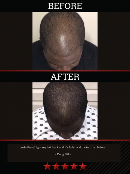 The All-Natural Hair Growth Solution by Black Widow® (Buy More & Save)