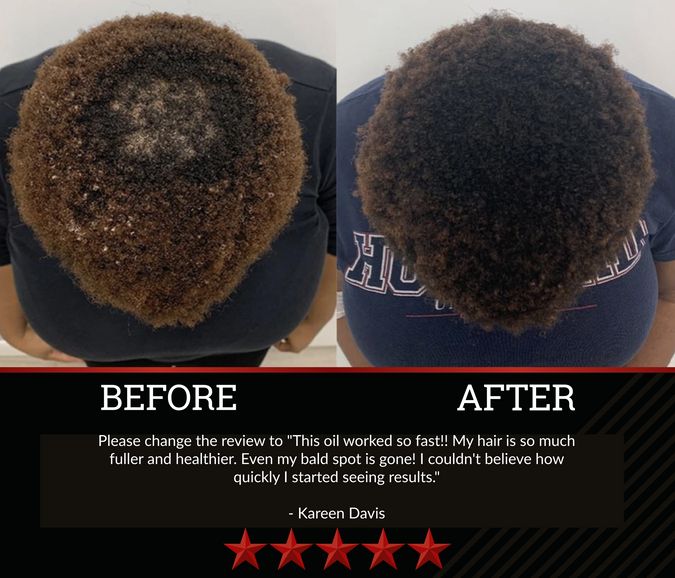 The All-Natural Hair Growth Solution by Black Widow® (Buy More & Save)