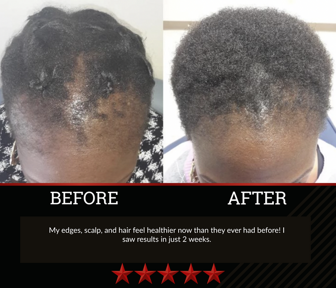 The All-Natural Hair Growth Solution by Black Widow® (Buy More & Save)