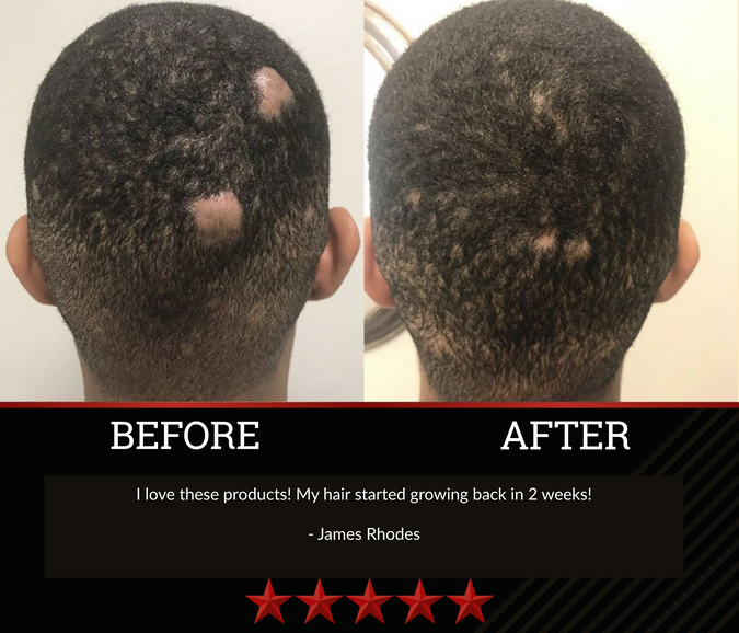 The All-Natural Hair Growth Solution by Black Widow® (Buy More & Save)