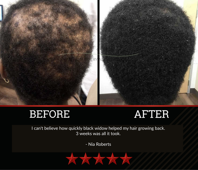 The All-Natural Hair Growth Solution by Black Widow® (Buy More & Save)